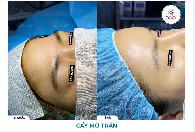SAU TIÊM MỠ TRÁN CÓ ĐẸP NGAY KHÔNG?