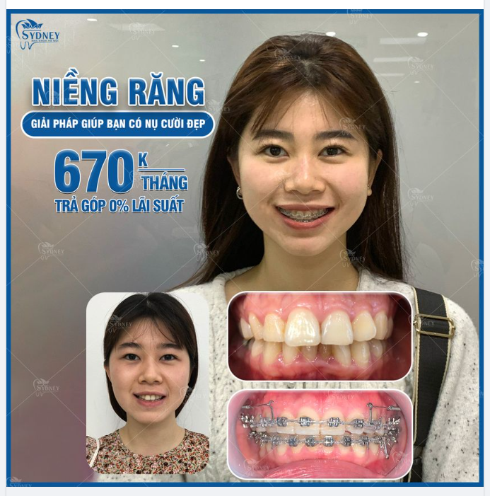 SỰ THAY ĐỔI SAU KHI NIỀNG RĂNG HÔ?