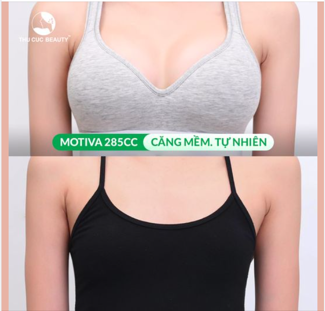 Xóa bỏ tự ti V1 teo lép nhờ Ngực TC