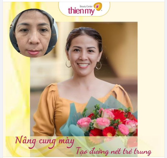 Nâng cung chân mày là phương pháp thẩm mỹ được đông đảo khách hàng trung niên lựa chọn để điều trị sụp mí.