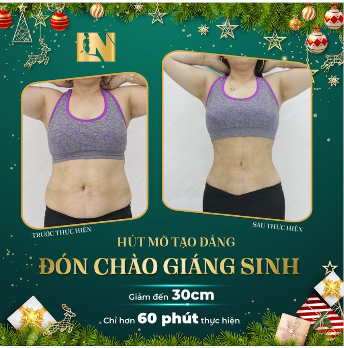 HÚT MỠ TẠO DÁNG - ĐÓN CHÀO GIÁNG SINH