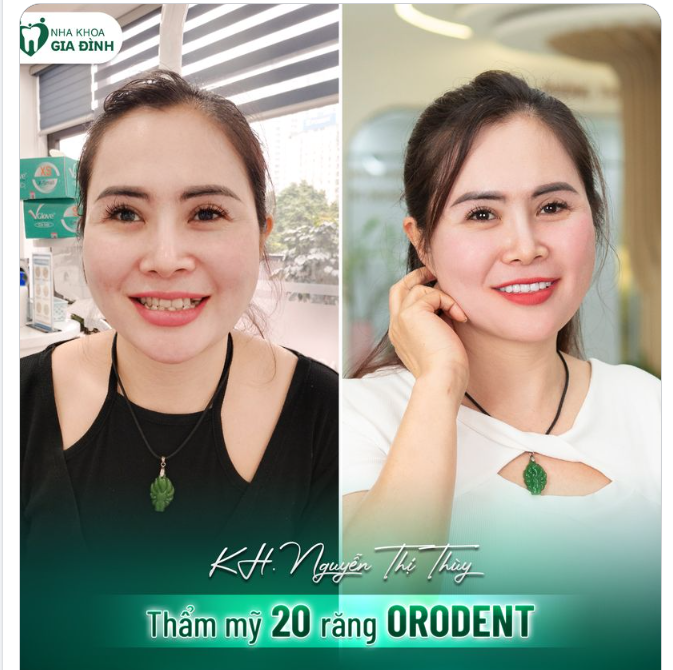 GƯƠNG MẶT BỪNG SÁNG RẠNG NGỜI CHỈ SAU 2 LẦN HẸN