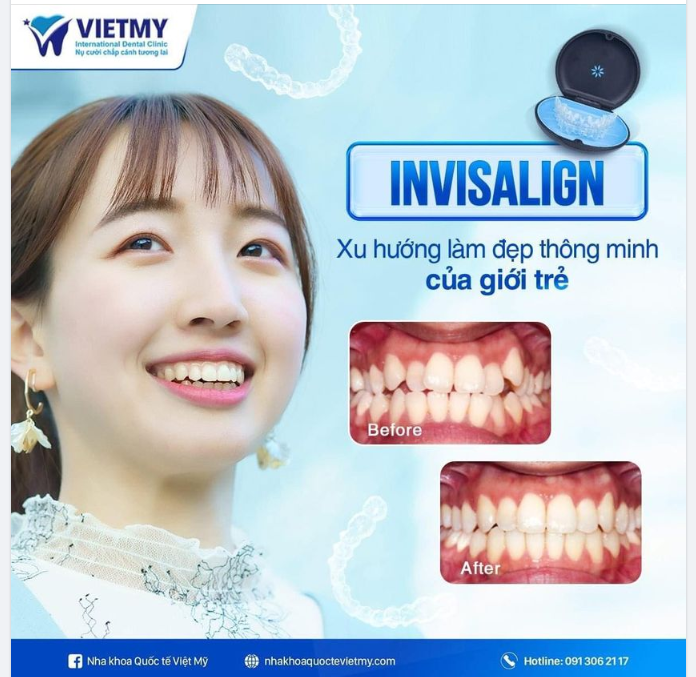 XINH LUNG LINH TRONG TỪNG KHUNG HÌNH TẾT CÙNG  INVISALIGN