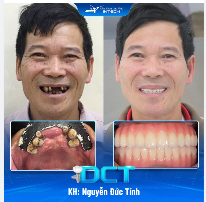 PHONG ĐỘ “XUỐNG DỐC” VÌ RĂNG HƯ HỎNG NẶNG, U70 TÌM LẠI SỨC SỐNG CHỈ SAU 3 THÁNG