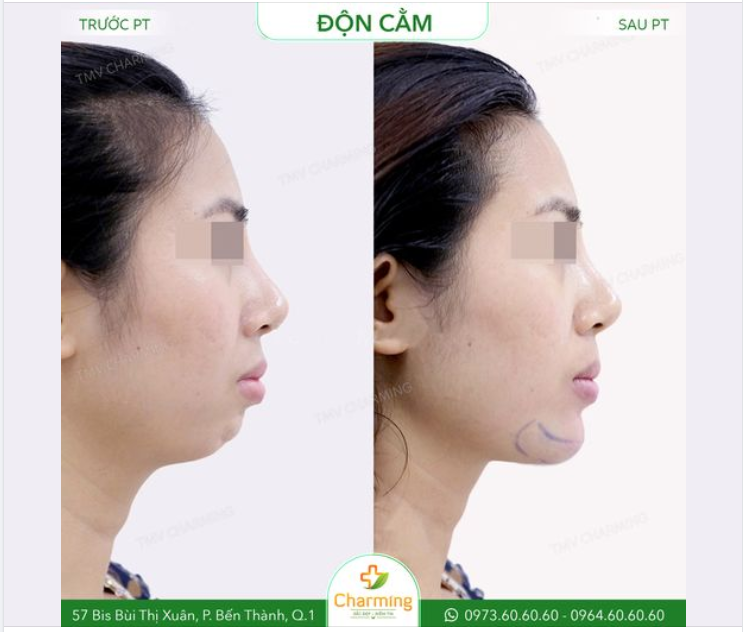 Nếu bạn chưa hình dung ra được sự kỳ diệu của phẫu thuật độn cằm thì đây là minh chứng cho sự kỳ diệu đó.