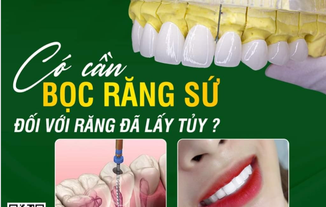 CÓ CẦN BỌC RĂNG SỨ ĐỐI VỚI RĂNG ĐÃ LẤY TỦY?
