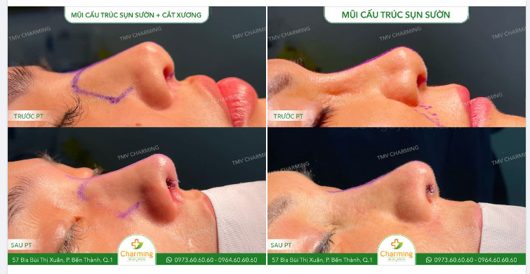 MŨI VẠT GÓC VUÔNG VÀ CÁCH KHẮC PHỤC ĐƠN GIẢN