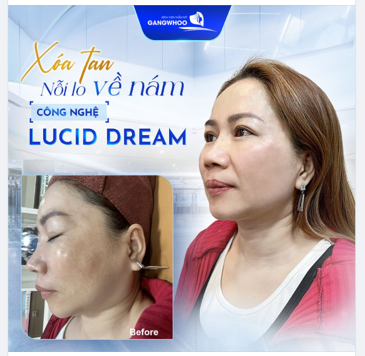 XÓA TAN NỔI LO VỀ NÁM CÙNG CÔNG NGHỆ LUCID DREAM