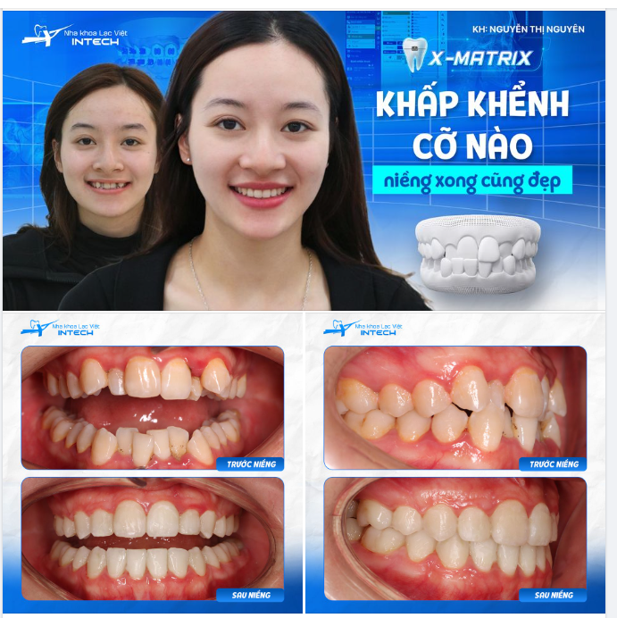 XÓA BỎ LỆCH HÀM, DÀN ĐỀU KHẤP KHỂNH SAU 20 THÁNG NIỀNG RĂNG!