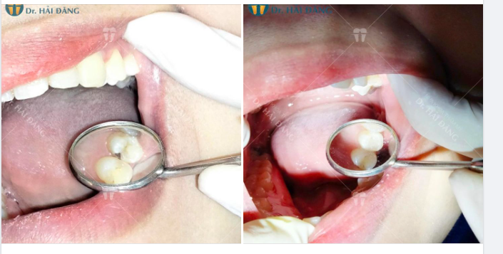 Hình ảnh trước và sau khi trám răng trị sâu kẽ của Khánh Phương.