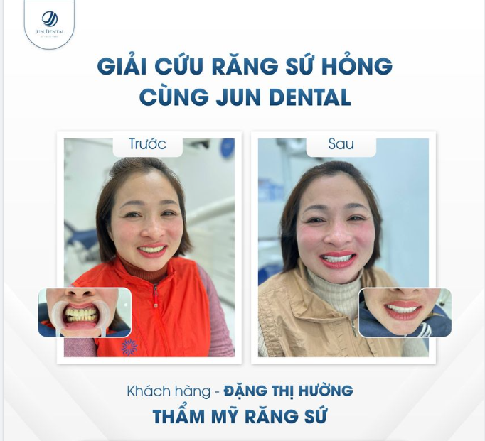 GIẢI CỨU RĂNG SỨ HỎNG TẠI JUN DENTAL