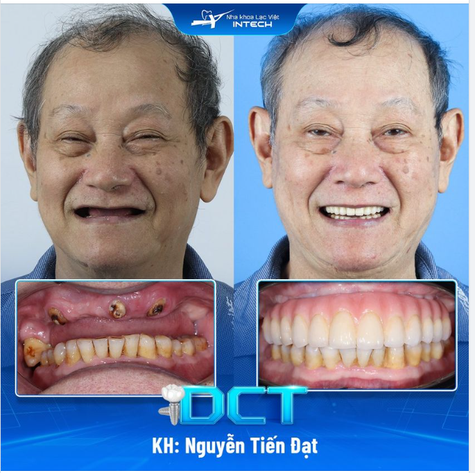TỔN THƯƠNG DẠ DÀY DO MẤT RĂNG, U70 CHỌN TRỒNG RĂNG IMPLANT TẠI LẠC VIỆT INTECH