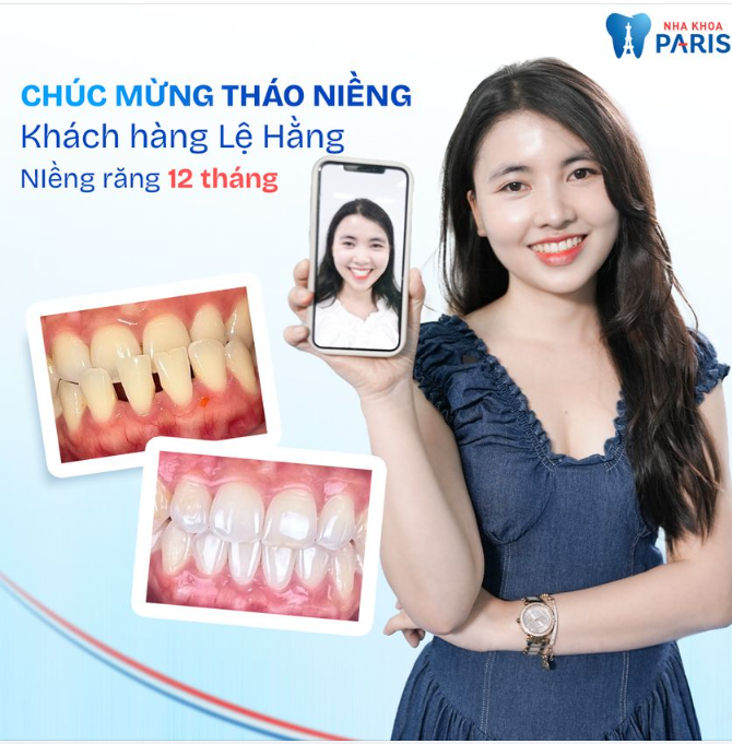 MỪNG THÁO NIỀNG - KH.LỆ HẰNG: NIỀNG INVISALIGN