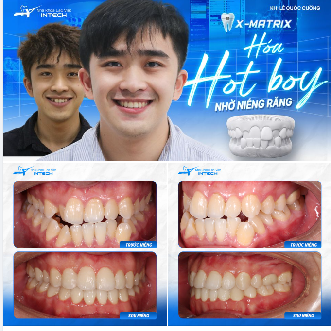 BỎ NGOÀI TAI NHỮNG LỜI KHUYÊN NGĂN, CHÀNG TRAI 9X VẪN QUYẾT TÂM THAY ĐỔI NỤ CƯỜI