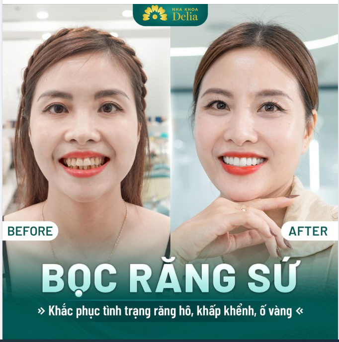 Cùng xem những thay đổi của chị Lệ sau khi sở hữu nụ cười mới rạng rỡ tại nha khoa Delia nhé!