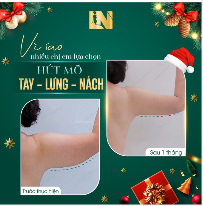 4 LÝ DO CHỊ EM LỰA CHỌN HÚT MỠ TAY - LƯNG - NÁCH TẠI EKIP BÁC SĨ LƯƠNG NGỌC?