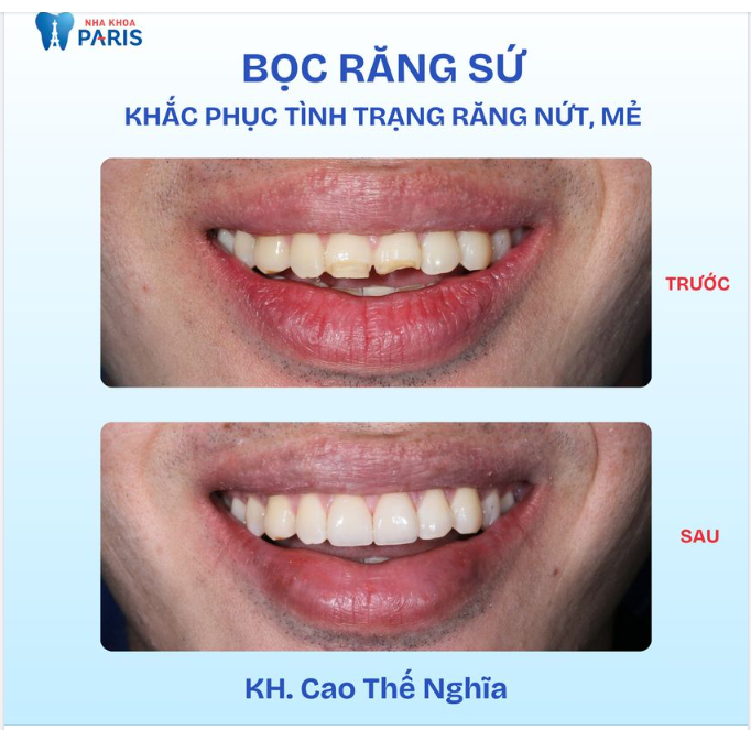 RĂNG BỊ MẺ PHẢI LÀM SAO?