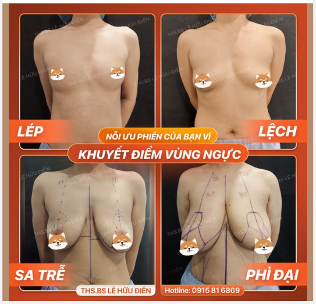 Nỗi ưu phiền của bạn vì khuyết điểm vùng ngực Lép Lệch Chảy sệ Phì đại