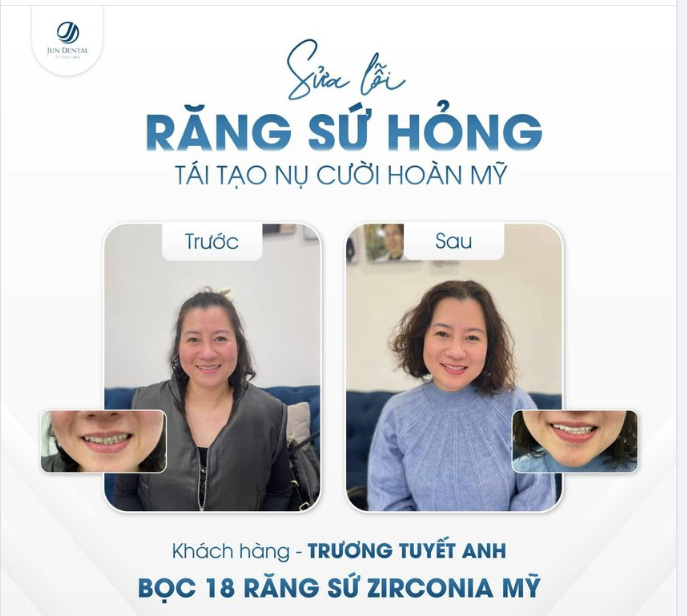 SỬA LỖI RĂNG SỨ HỎNG - TÁI TẠO NỤ CƯỜI HOÀN MỸ