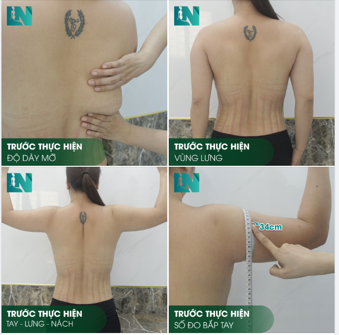 HÌNH ẢNH TRƯỚC KHI THỰC HIỆN COMBO HÚT MỠ TAY - LƯNG - NÁCH