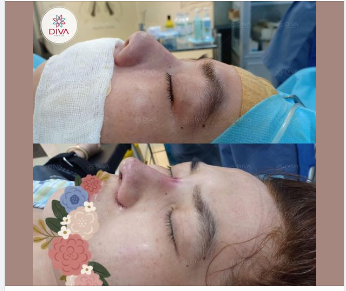 Mũi hếch Mũi thấp Chóp mũi to Tất cả sẽ được khắc phục sau thẩm mỹ Nâng mũi Sline tại DIVA