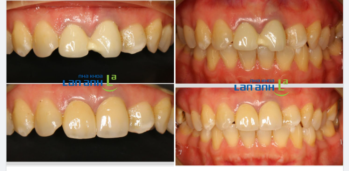 PHỤC HÌNH RĂNG SỨ NACERA CHO TRƯỜNG HỢP RĂNG MẺ TO