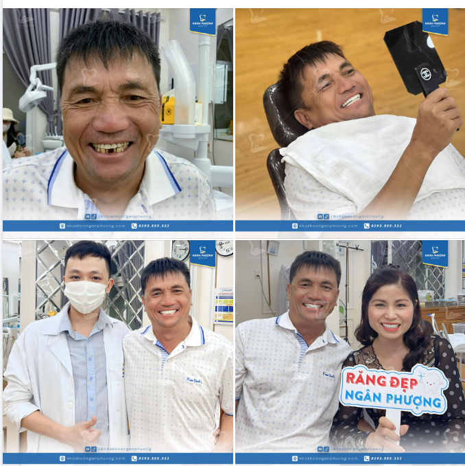 Phục hình implant răng cửa và làm răng sứ mới, anh Vượng đã phải thốt lên: "Không uổng công đi từ Đà Lạt xuống gặp bác sĩ Dũng"