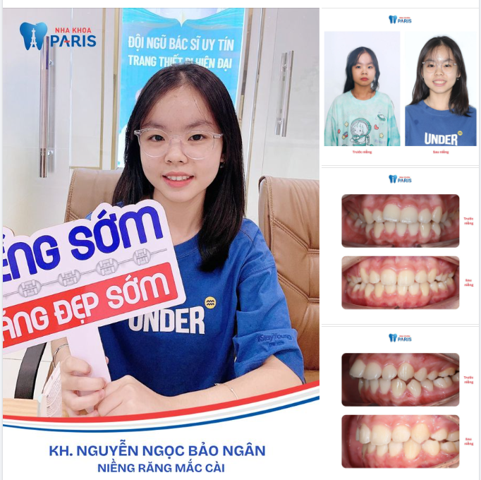NIỀNG SỚM CHO TRẺ - LỢI ĐỦ ĐƯỜNG!