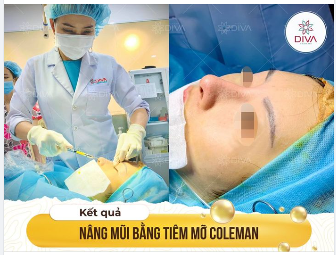 KẾT QUẢ THẨM MỸ TIÊM MỠ COLEMAN NÂNG CAO SỐNG MŨI