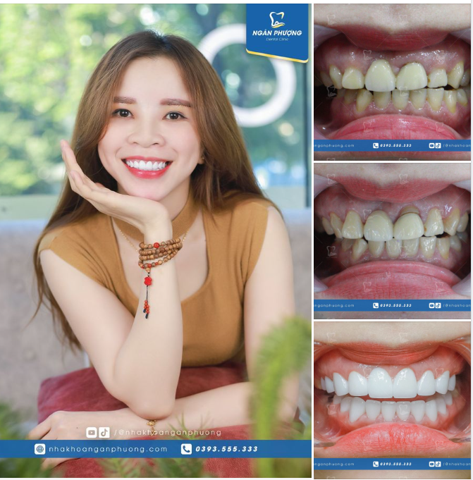 Cắt lợi điều trị viêm, làm dài thân răng và làm răng sứ mới đã "nâng cấp" nụ cười chị Thúy An x1000 lần