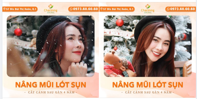 Nếu mọi người còn thắc mắc là hiệu quả nâng mũi sẽ kéo dài được bao lâu thì nàng khách sau đây là một ví dụ cụ thể cho mọi người.