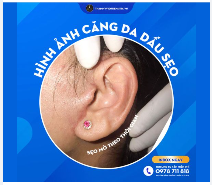 Flex kỹ thuật Căng da dấu sẹo tại Dr.Trí
