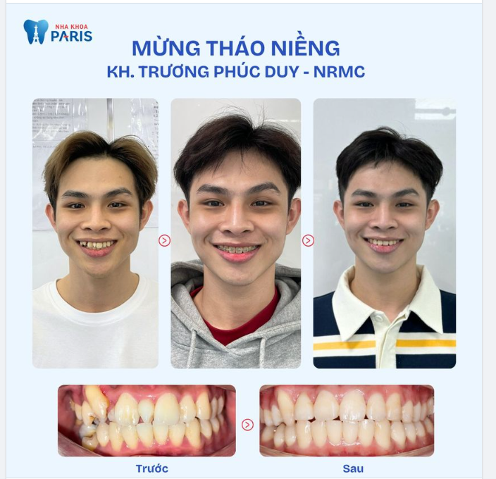 THAY ĐỔI DIỆN MẠO VỚI NỤ CƯỜI MỚI