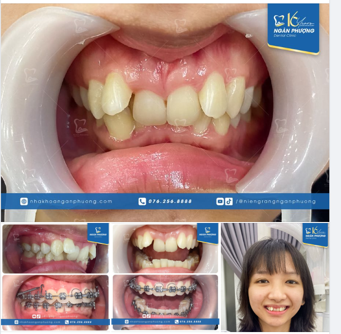 Niềng răng 8 tháng, 360 độ góc nào cũng đẹp