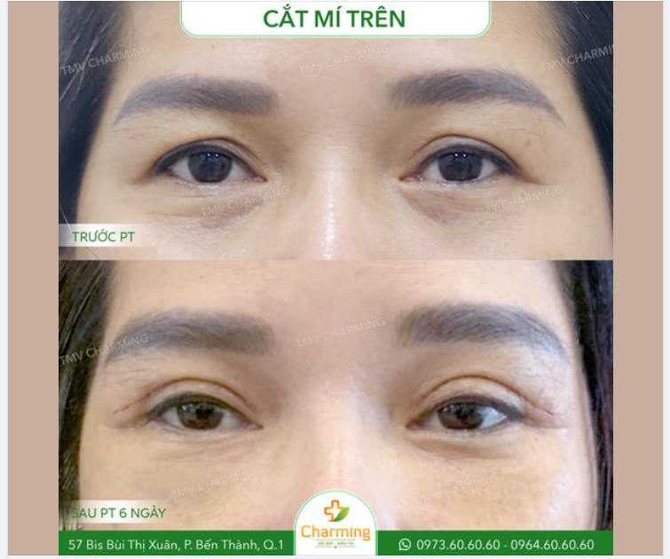 Phần da chùng ở vùng mí trên đã khiến tầm nhìn của nàng khách bị hạn chế mà còn làm cho gương mặt nàng trông ủ rũ, lờ đờ.