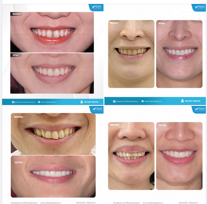 Còn nếu răng bạn bị "nhuốm màu", hãy để Peace Dentistry đồng hành tô điểm hàm răng trở nên trắng sáng rạng rỡ cho nụ cười thêm xinh nhé