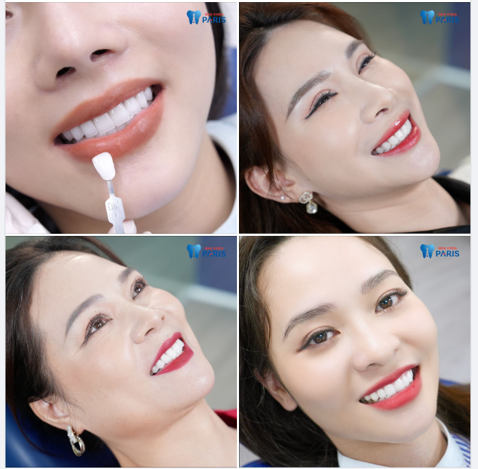 "Nhả vía" răng xinh cho chị em đón Tết