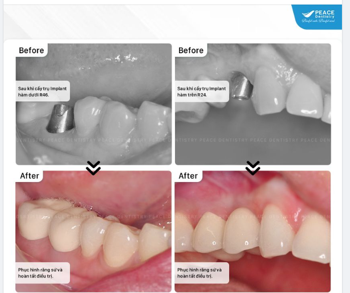  MẤT RĂNG HÀM SỐ 6 - IMPLANT LÀ LỰA CHỌN LÝ TƯỞNG, BỀN VỮNG. HÃY THỰC HIỆN CÀNG SỚM CÀNG TỐT!