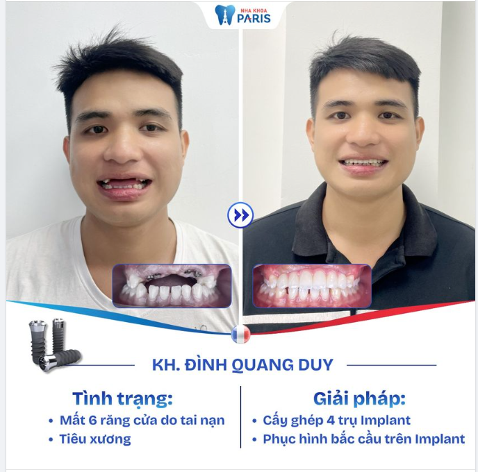 MẤT RĂNG DO TAI NẠN, PHỤC HÌNH CHỈ SAU 1 THÁNG