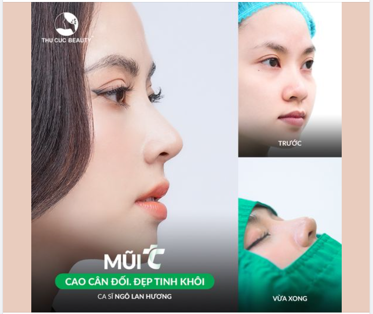 5 NGÀY tạm biệt sống mũi thấp, đầu mũi to cùng ca sĩ Ngô Lan Hương