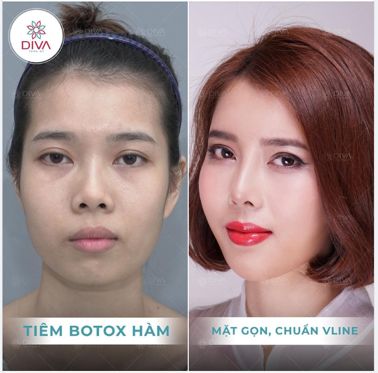 SỞ HỮU CẰM THON GỌN VLINE KHÔNG PHẪU THUẬT SAU TIÊM BOTOX