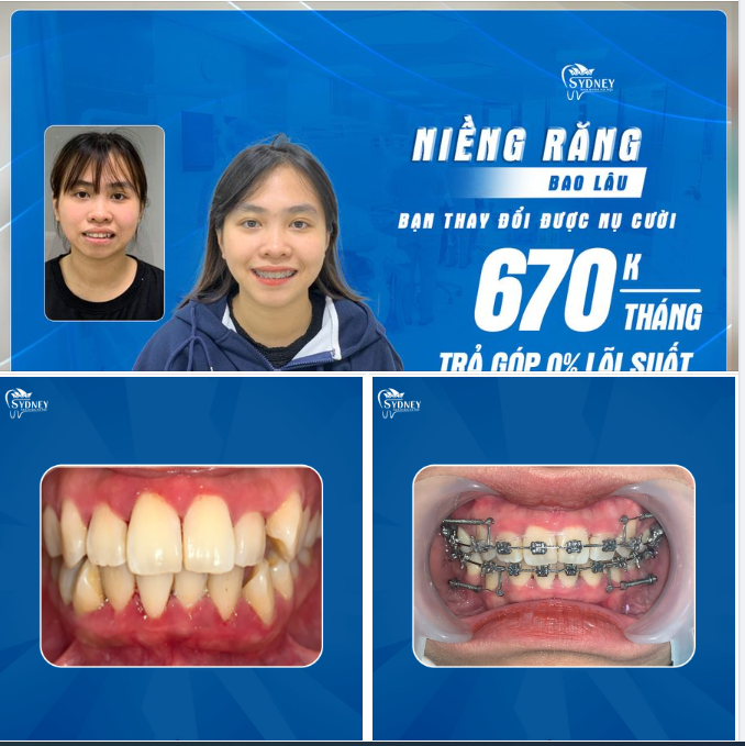 NIỀNG RĂNG BAO LÂU SẼ NHẬN THẤY SỰ THAY ĐỔI?