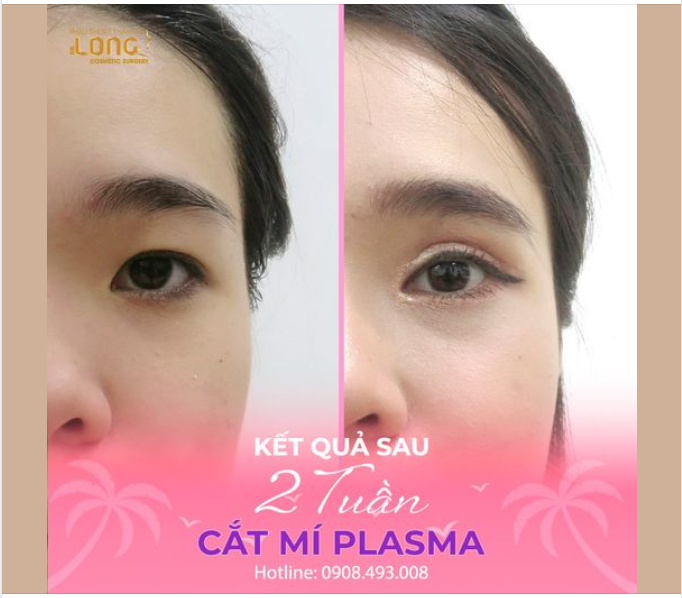 Đôi mắt 2 mí không chỉ giúp bạn trẻ đẹp còn giúp bạn thêm thu hút nổi bật khi gặp gỡ mọi người. Tăng tự tin, thành công sẽ đến với bạn khi thay đổi sắc diện mới.