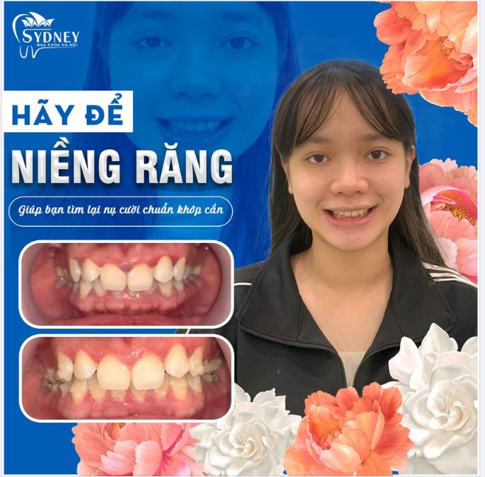 KHI NÀO BẠN NÊN NIỀNG RĂNG?
