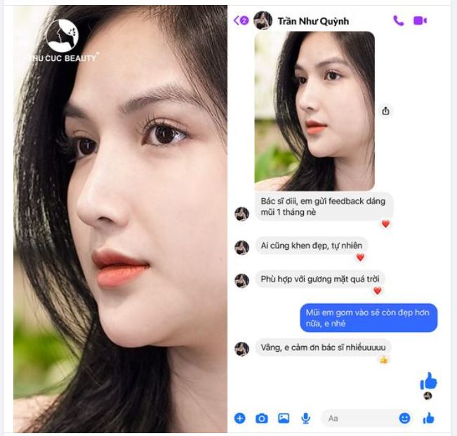 5 ngày tạm biệt sống mũi thấp, đầu mũi to