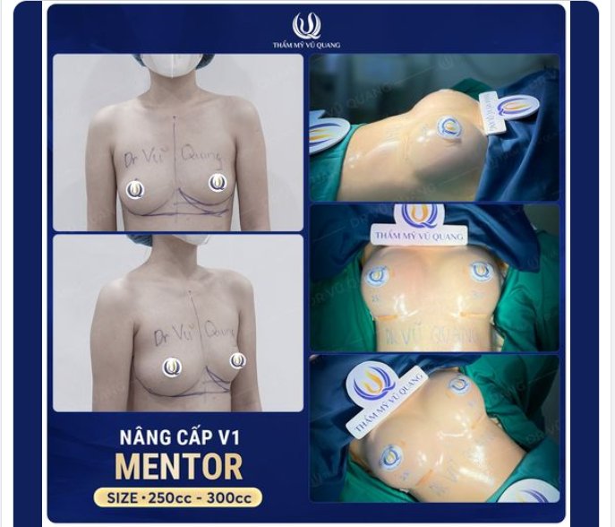 Ngực bạn có đang bị lệch?