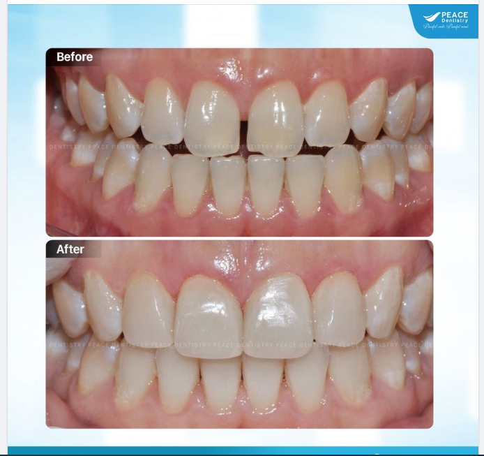 VENEER ĐÓNG KÍN KHE THƯA VÀ BẢO TỒN TỐI ĐA RĂNG THẬT