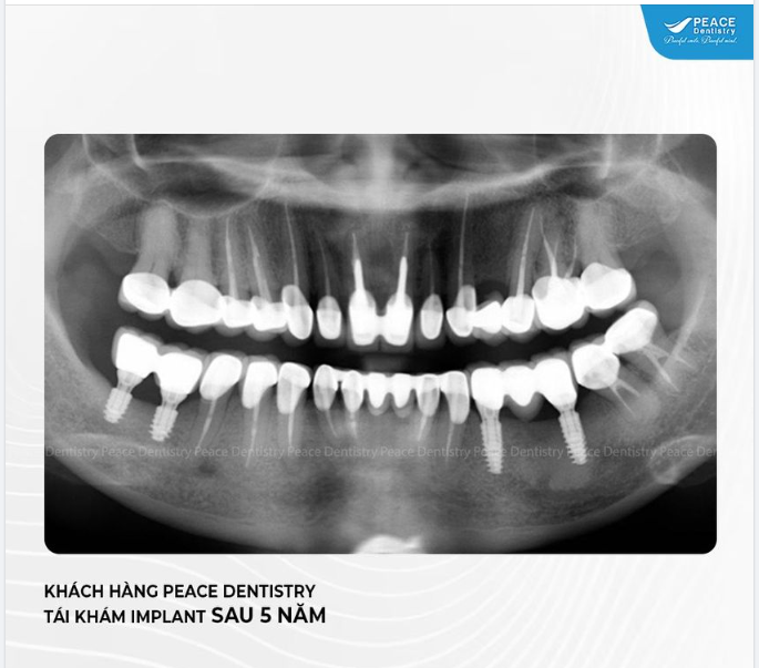 TÁI KHÁM IMPLANT BỀN VỮNG SAU 5 NĂM MINH CHỨNG ĐIỀU GÌ?