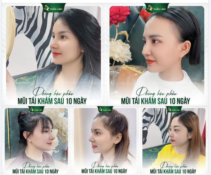 Ghé thăm phòng hậu phẫu - Những dáng mũi sau 10 ngày nâng tại Tuấn Linh!!