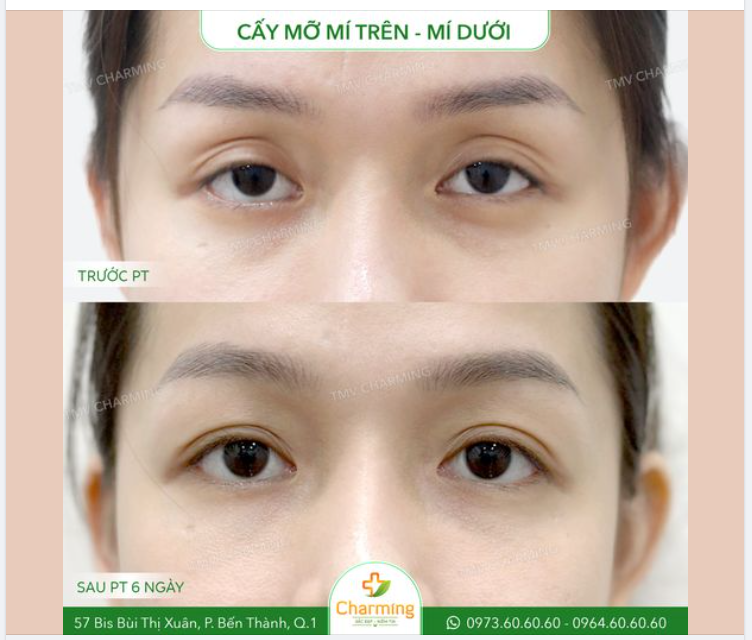 Đôi mắt lẫn thần sắc của nàng khách thay đổi ngoạn mục sau khi cấy mỡ mí trên và dưới.